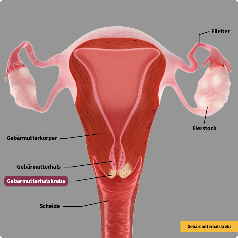 Gebärmutterhalskrebs. Bösartige Zellen wachsen in das umliegende Gewebe ein (invasives Karzinom).