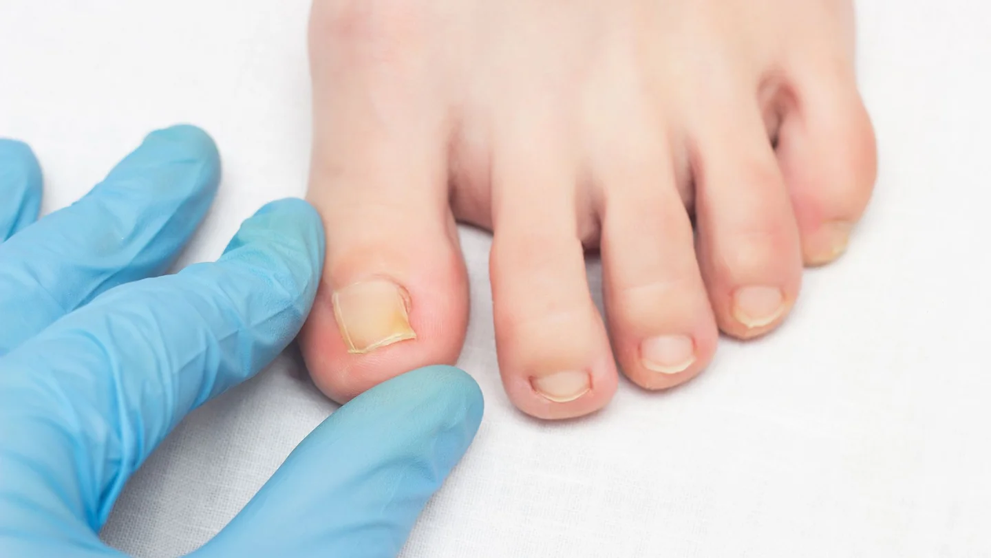 Ein Arzt berührt mit zwei Fingern in einem Handschuh einen großen Zeh an dem der Nagel eingewachsen ist. Die Haut um den Nagel herum ist leicht gerötet.
