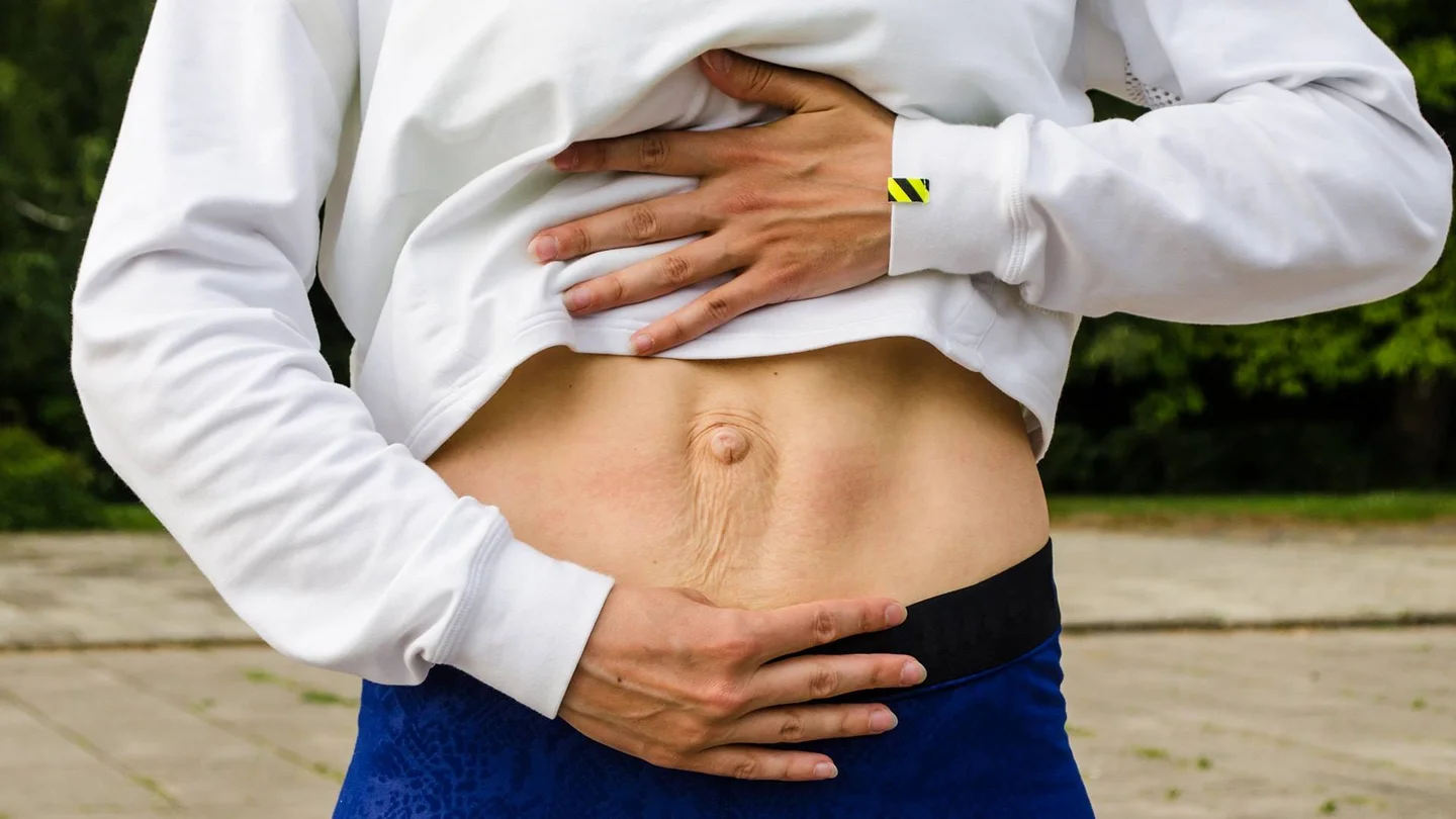 Bauch einer Person: Beidseits vom Nabel verlaufen senkrecht die Muskelstränge, die auseinanderweichen und einen Spalt bilden.
