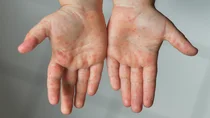 Kinderh&auml;nde mit fleckenartigem Hautausschlag
