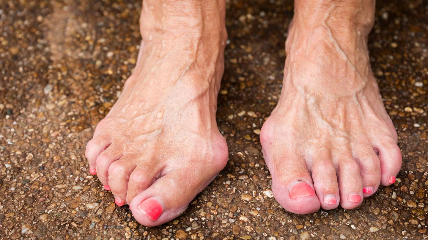 Hallux Valgus: Zwei Frauenf&uuml;&szlig;e stehen auf dem Boden. An einem Fu&szlig; sind die Gro&szlig;zehen gespreizt, haben eine Fehlstellung.