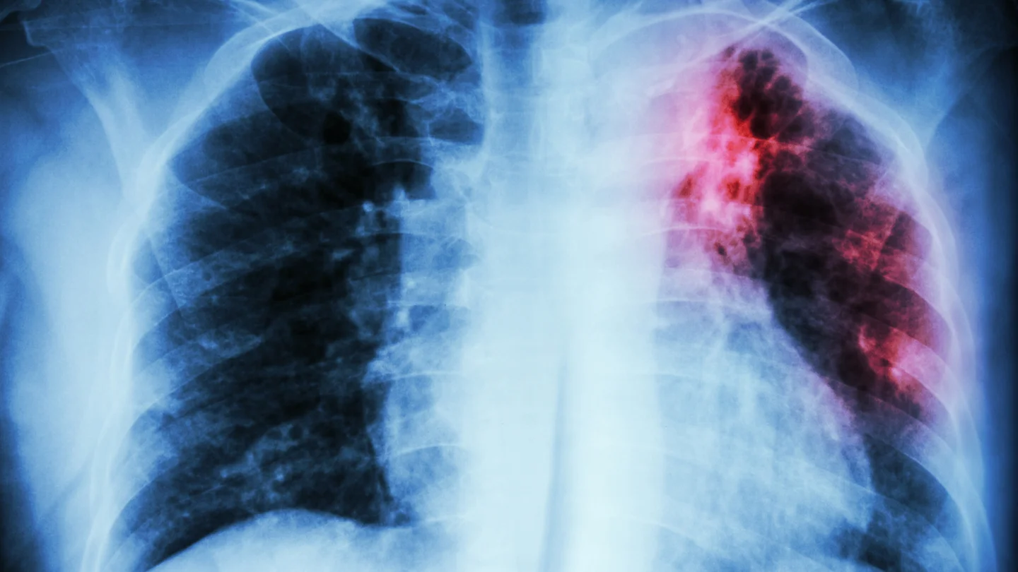 Tuberkulose: Eine R&ouml;ntgenaufnahme des Brustkorbs. Eine rot-schwarze Verf&auml;rbung im linken Lungenfl&uuml;gel weist auf eine Tuberkuloseinfektion hin.