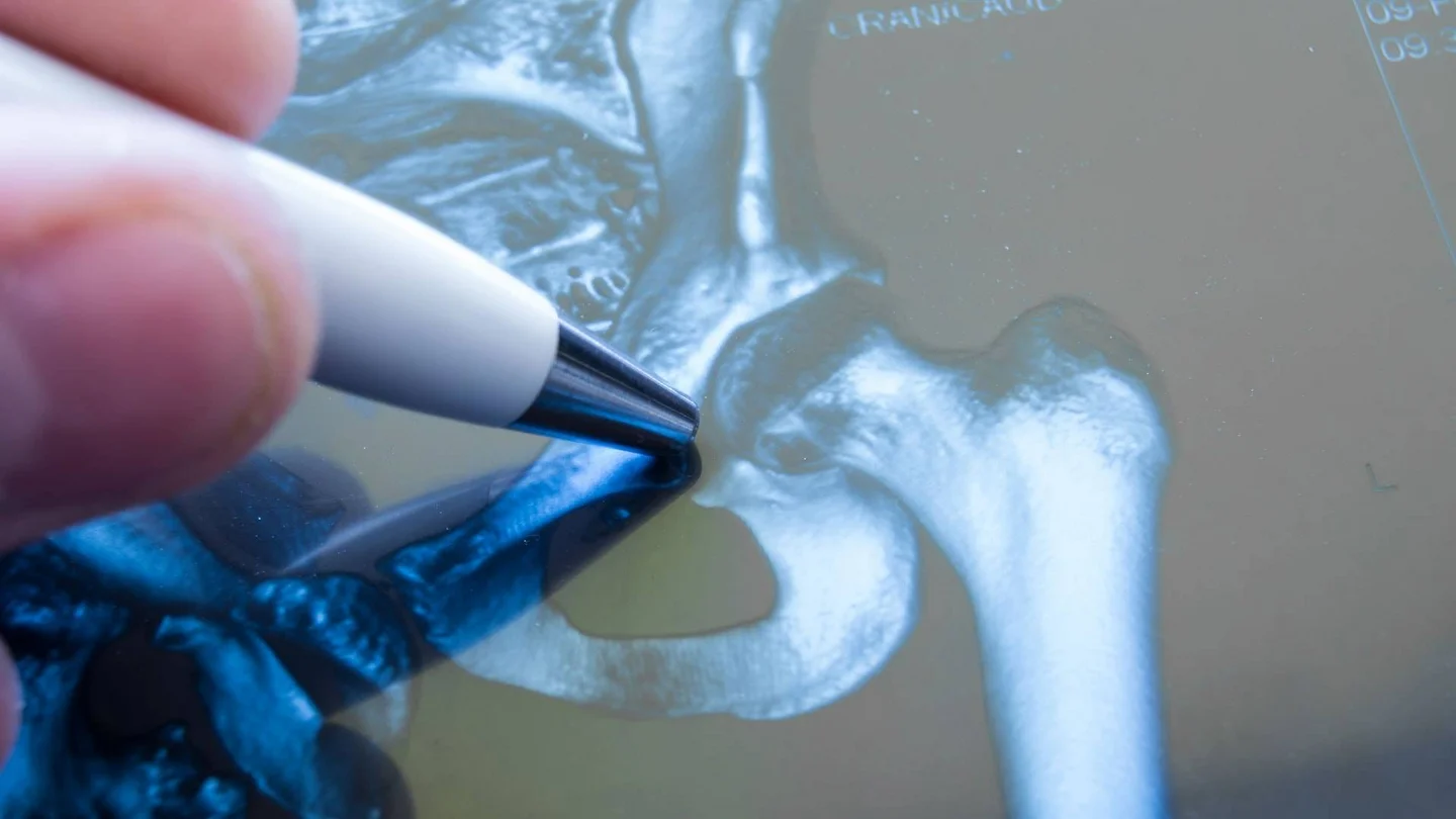 Nahaufnahme von Oberschenkelknochen und Hüftgelenkspfanne