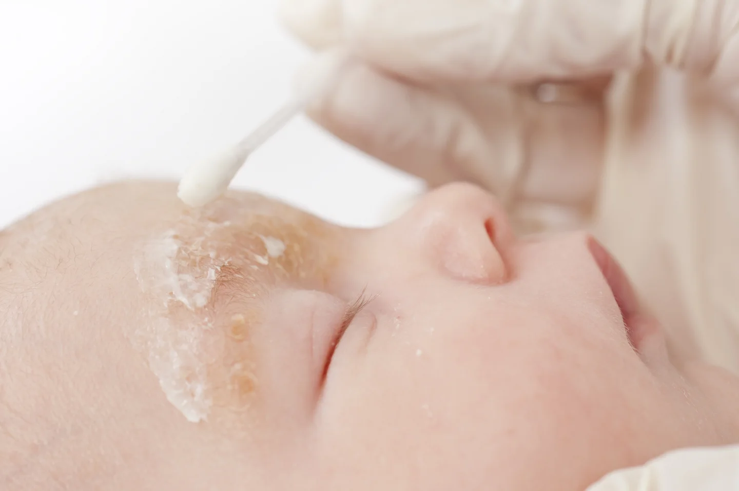 Ein Baby liegt auf einem Kissen. &Uuml;ber den Augenbrauen ist die Haut gelblich verf&auml;rbt und geschuppt. Eine Person tr&auml;gt Salbe auf die entz&uuml;ndete Hautstellen auf.