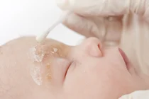 Ein Baby liegt auf einem Kissen. &Uuml;ber den Augenbrauen ist die Haut gelblich verf&auml;rbt und geschuppt. Eine Person tr&auml;gt Salbe auf die entz&uuml;ndete Hautstellen auf.