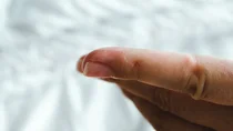 Zu sehen ist ein Zeigefinger mit mehreren zusammenh&auml;ngenden Bl&auml;schen.