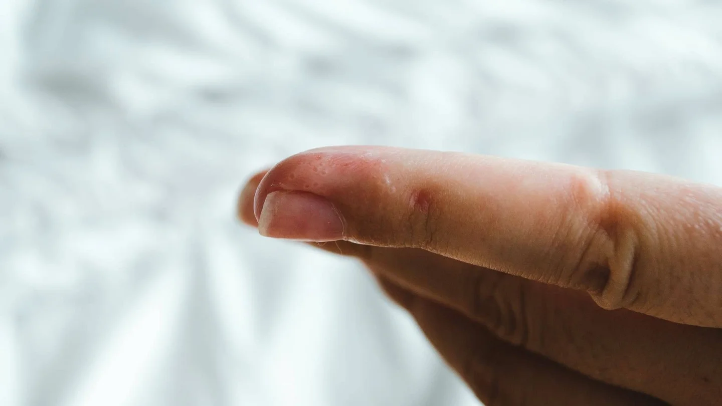 Zu sehen ist ein Zeigefinger mit mehreren zusammenh&auml;ngenden Bl&auml;schen.