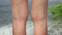 Nesselsucht: Die nackten Beine eines Menschen sind mit einem Ausschlag &uuml;berzogen. Der Ausschlag ist leicht r&ouml;tlich und wirkt geschwollen.