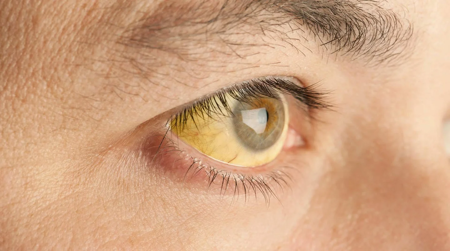 Gelblich verf&auml;rbtes Auge